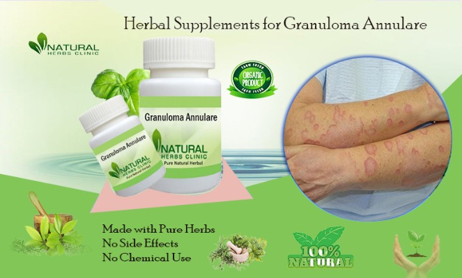 Natural Remedies for Granuloma Annulare: Transform Your Skin Health Today | Vipon