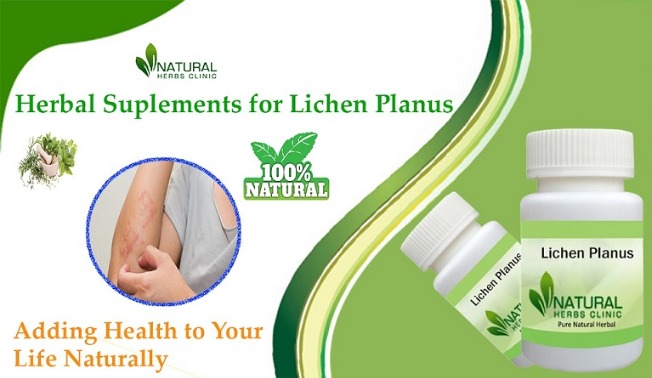 The Best Natural Lichen Planus Treatments: Transform Your Skin | Vipon