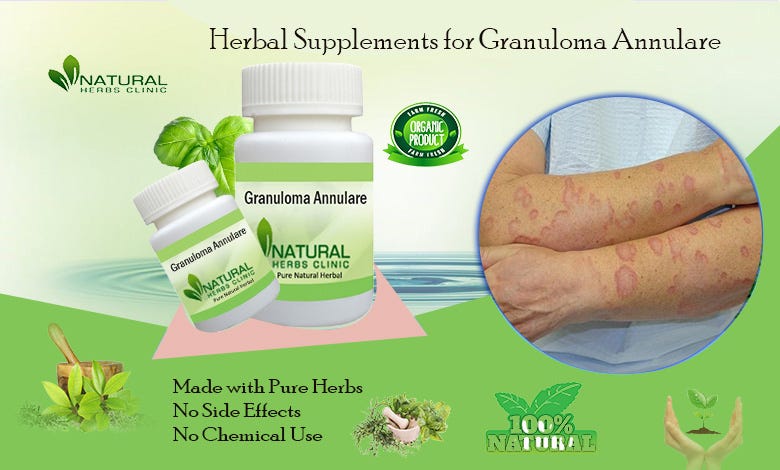 Say Goodbye to Granuloma Annulare with These Proven Remedies! | by Ellis Jhon | Sep, 2024 | Medium