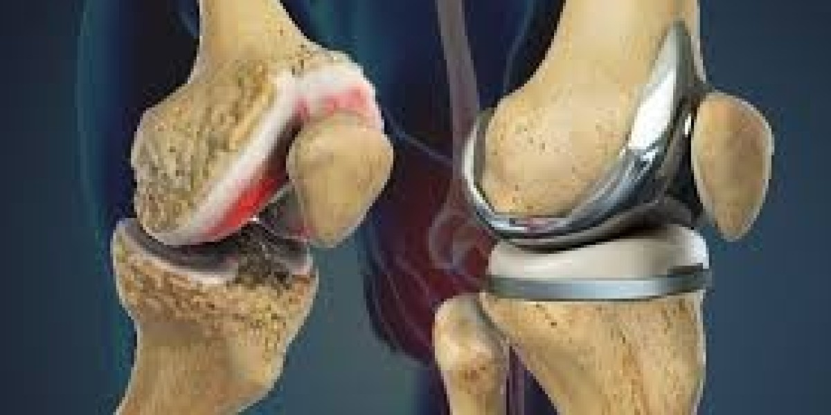 Global Knee Replacement Market Size And Forecast Report 2024-2032