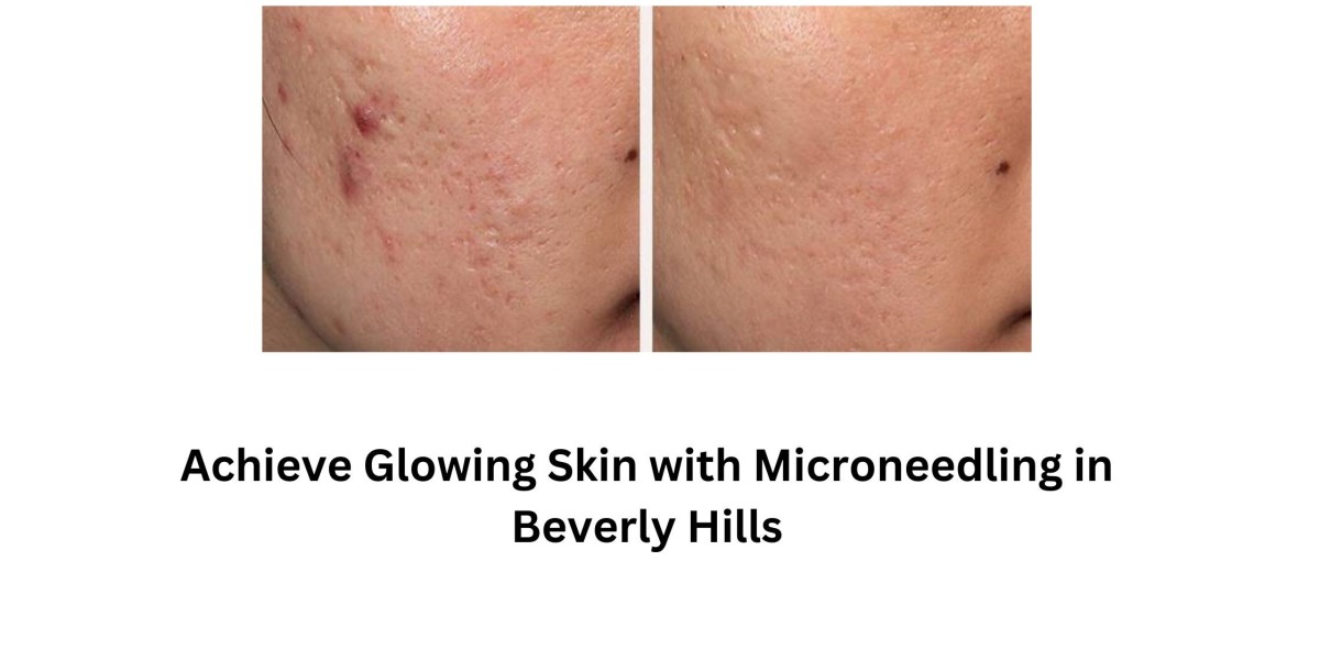 Achieve Glowing Skin with Microneedling in Beverly Hills