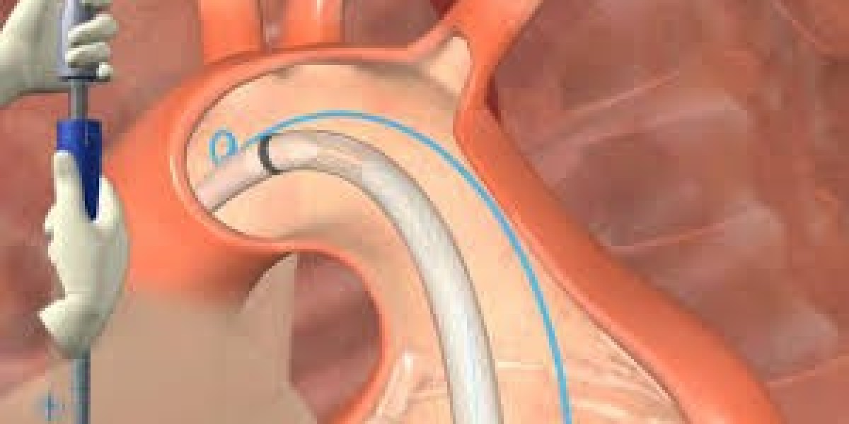 Endovascular Aneurysm Repair Market Size And Forecast Report By Renub Research