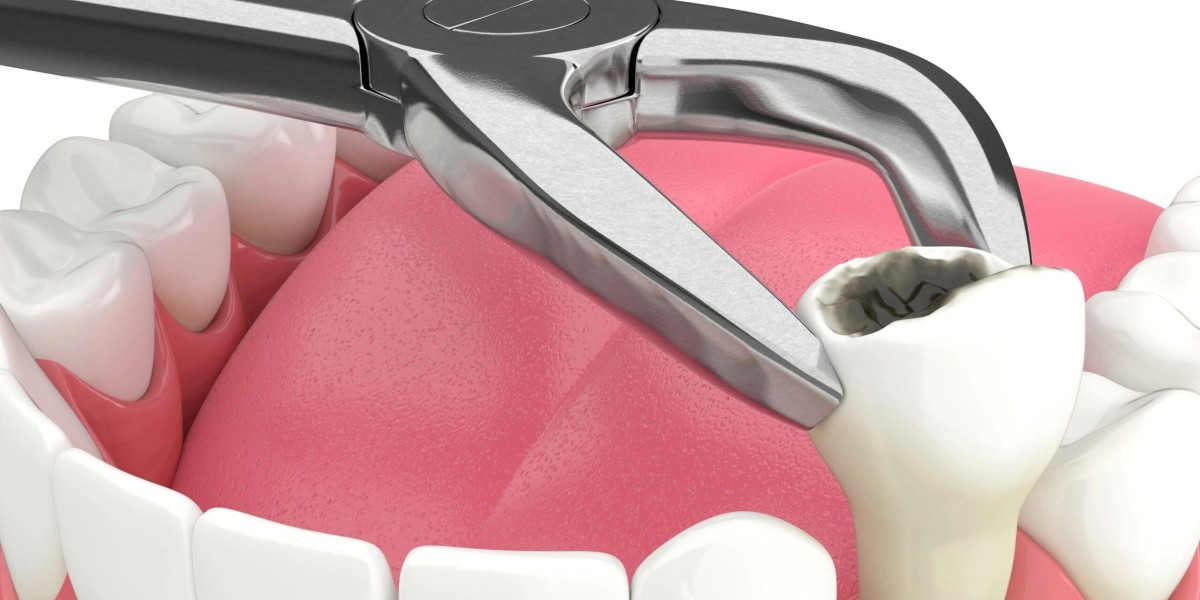 Comprehensive Dental Solutions: Tooth Extraction and All-on-4 Dental Implants in Bakersfield with San Dimas Dental Care